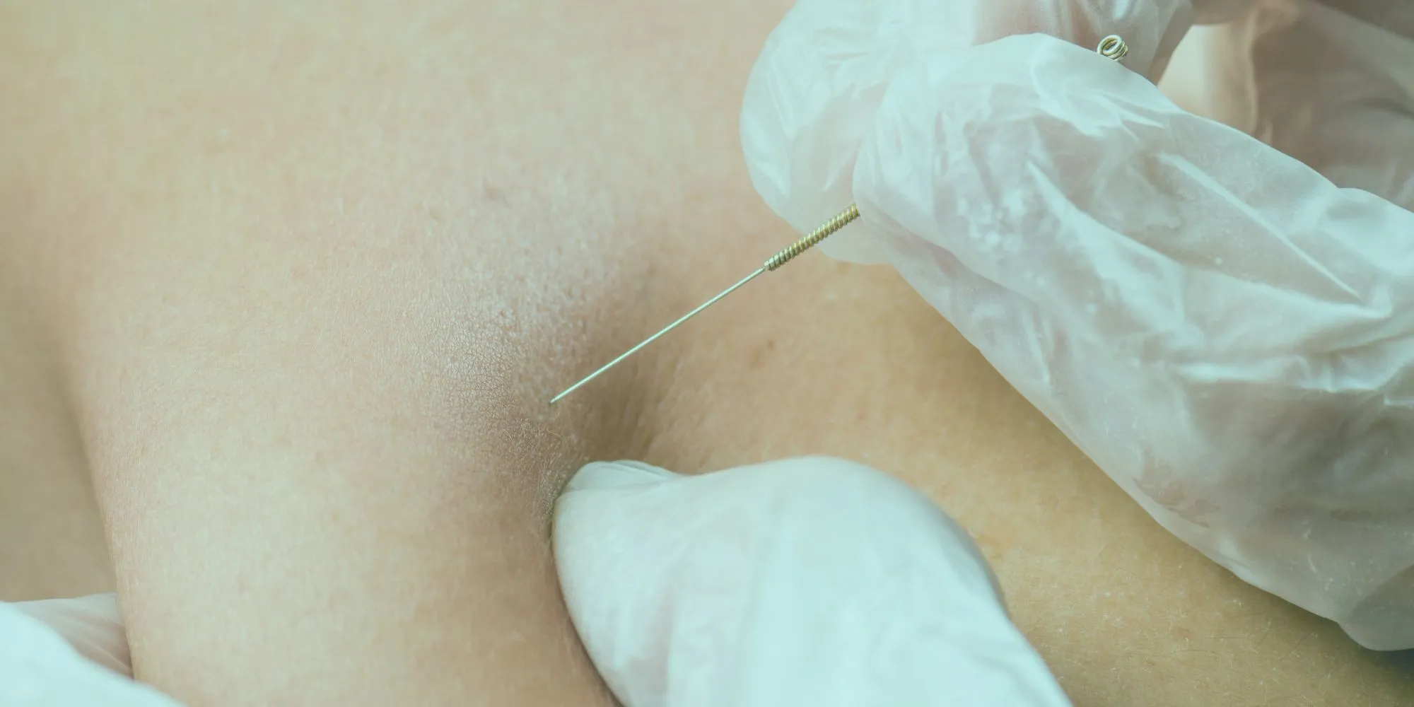 Dry Needling